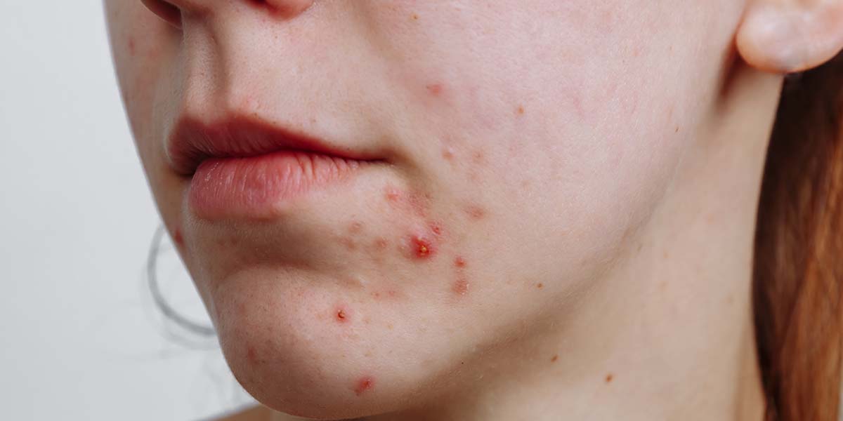 Holistic help for Acne