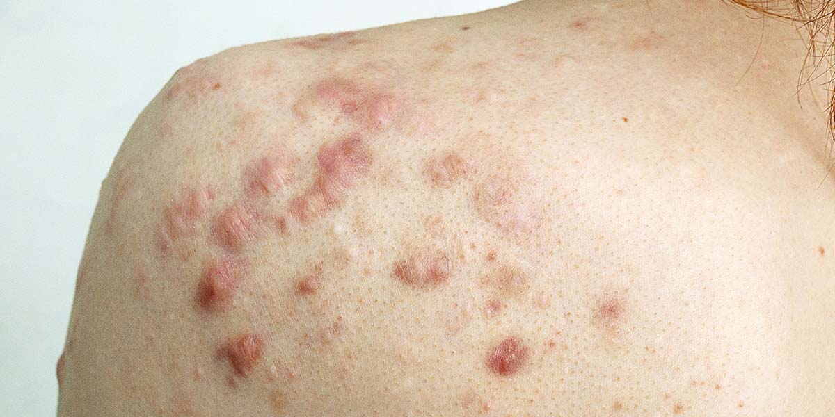 Types of Acne Scars and How To Help Them