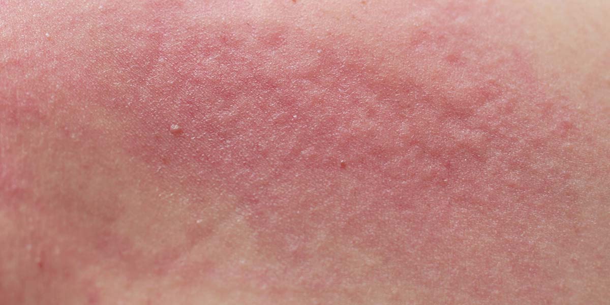 Is My Skin Sensitive or Sensitised?