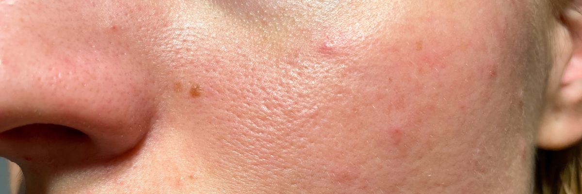 Damaged Skin Barrier? Here’s What to Do