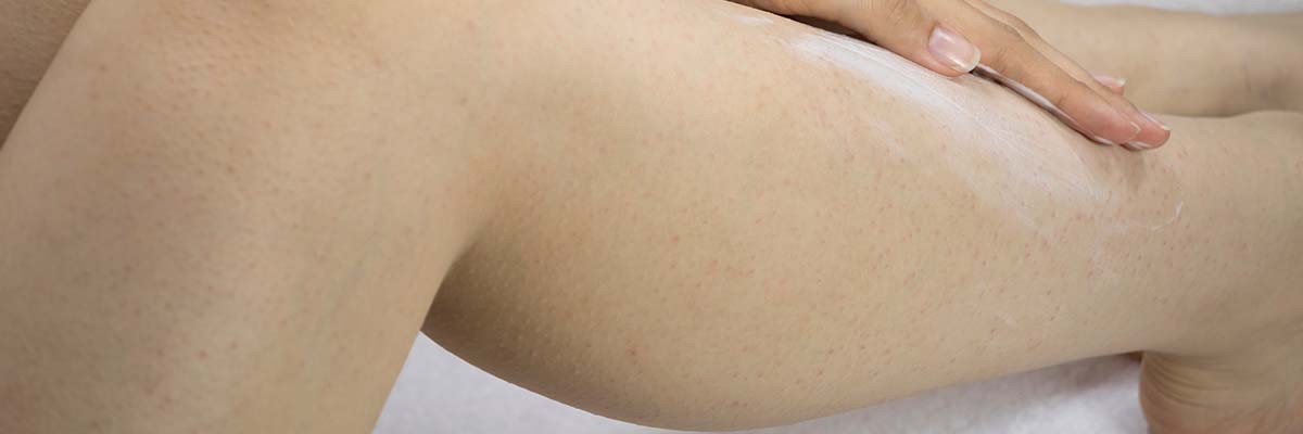 Do you have Keratosis Pilaris?
