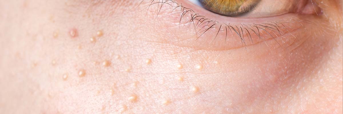 Milia Dos and Don’ts: What Causes Milia + How to Care for Your Skin