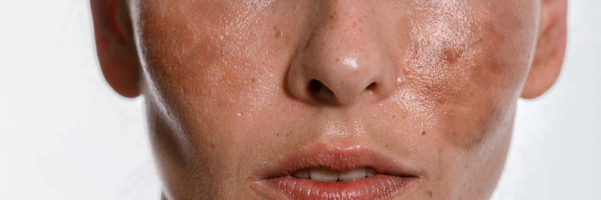 Hyperpigmentation Dos & Don'ts: 10 Skincare Mistakes to Avoid