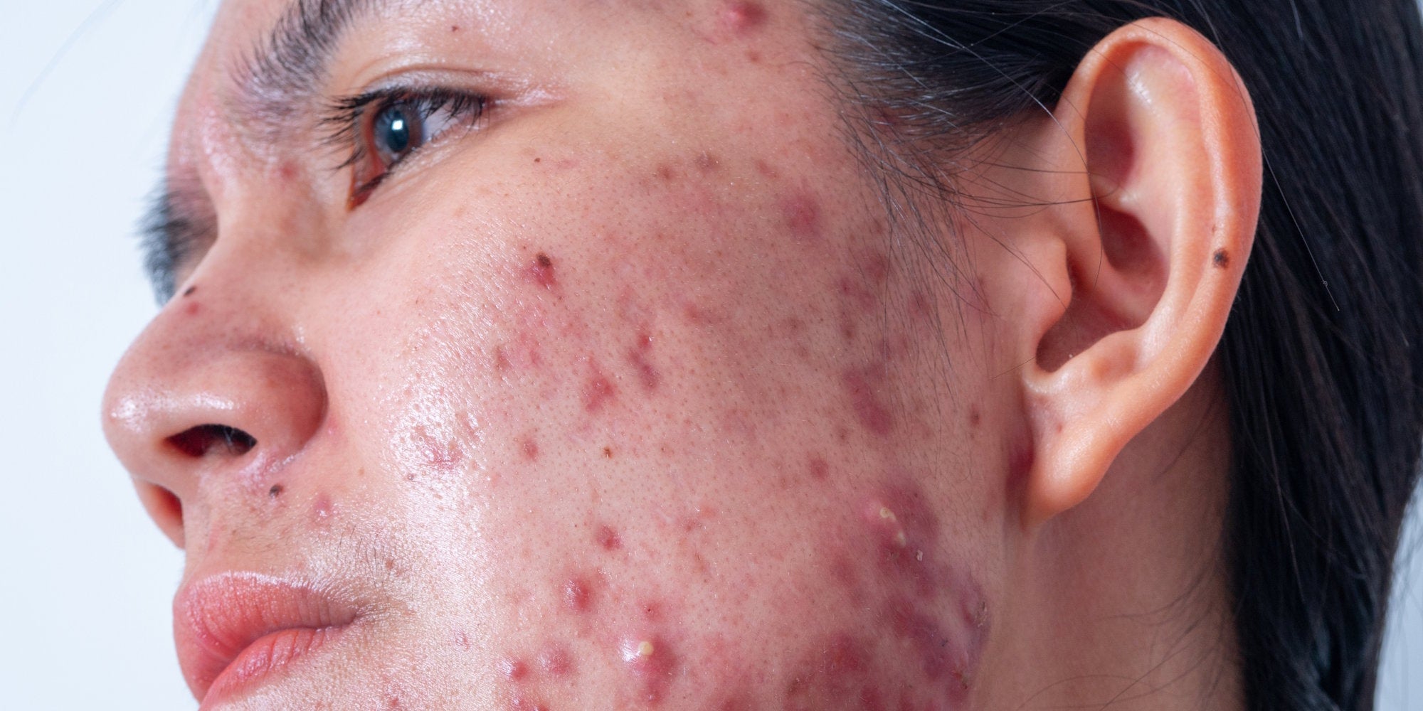AMPERNA-Acne-Banner.jpg