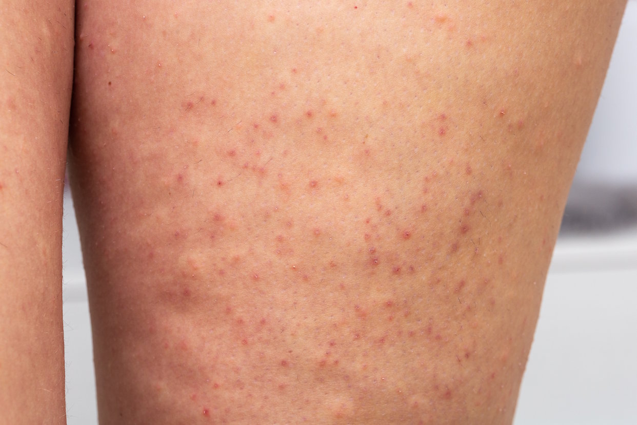 AMPERNA-Keratosis-Pilaris.jpg