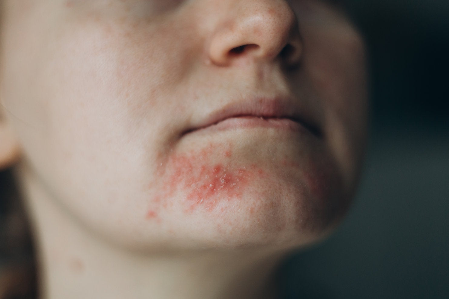 AMPERNA-Perioral-Dermatitis.jpg