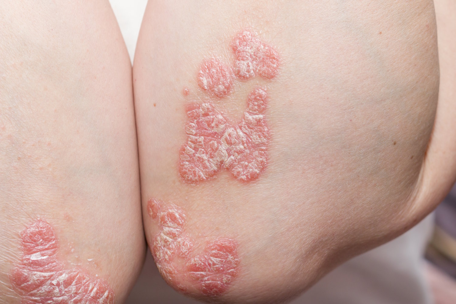 AMPERNA-Psoriasis.jpg