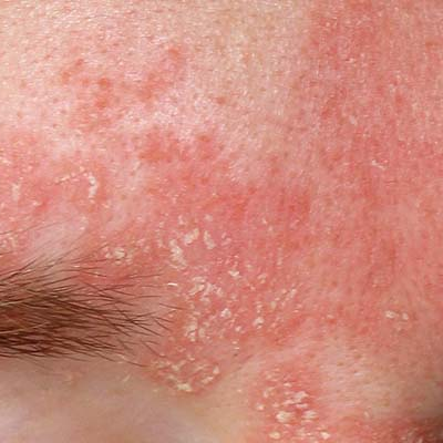 AMPERNA-Seborrheic-Dermatitis-Forehead.png