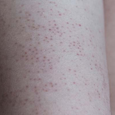 Amperna-keratosis1.png