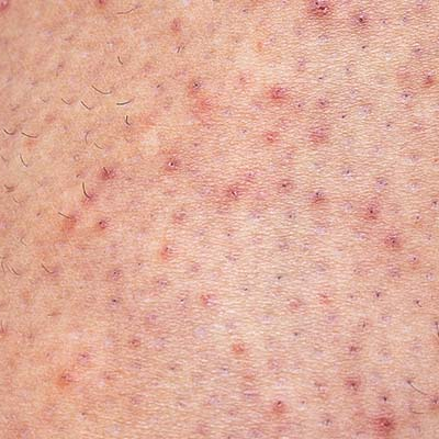 ghk cu keratosis pilaris Postbiotic Skincare
