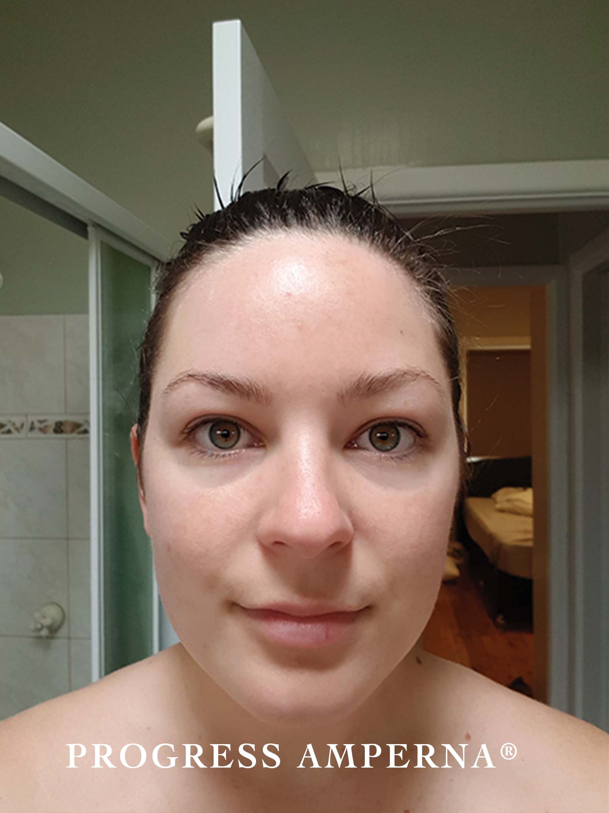 Amperna-pigmenation-after.jpg