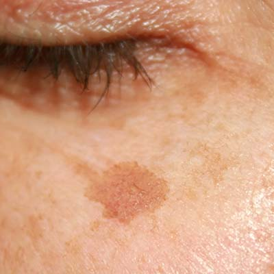 Amperna-pigmentation_age_spots.png