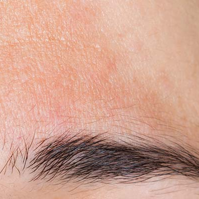 Amperna-pigmentation_forehead.png