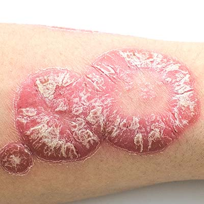 Amperna-psoriasis3.png