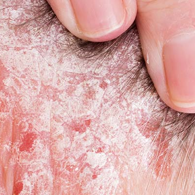 Amperna-psoriasis4.png