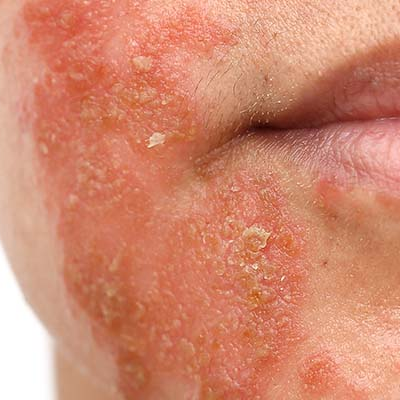 amperna_Seborrheicdermatitis_4.png