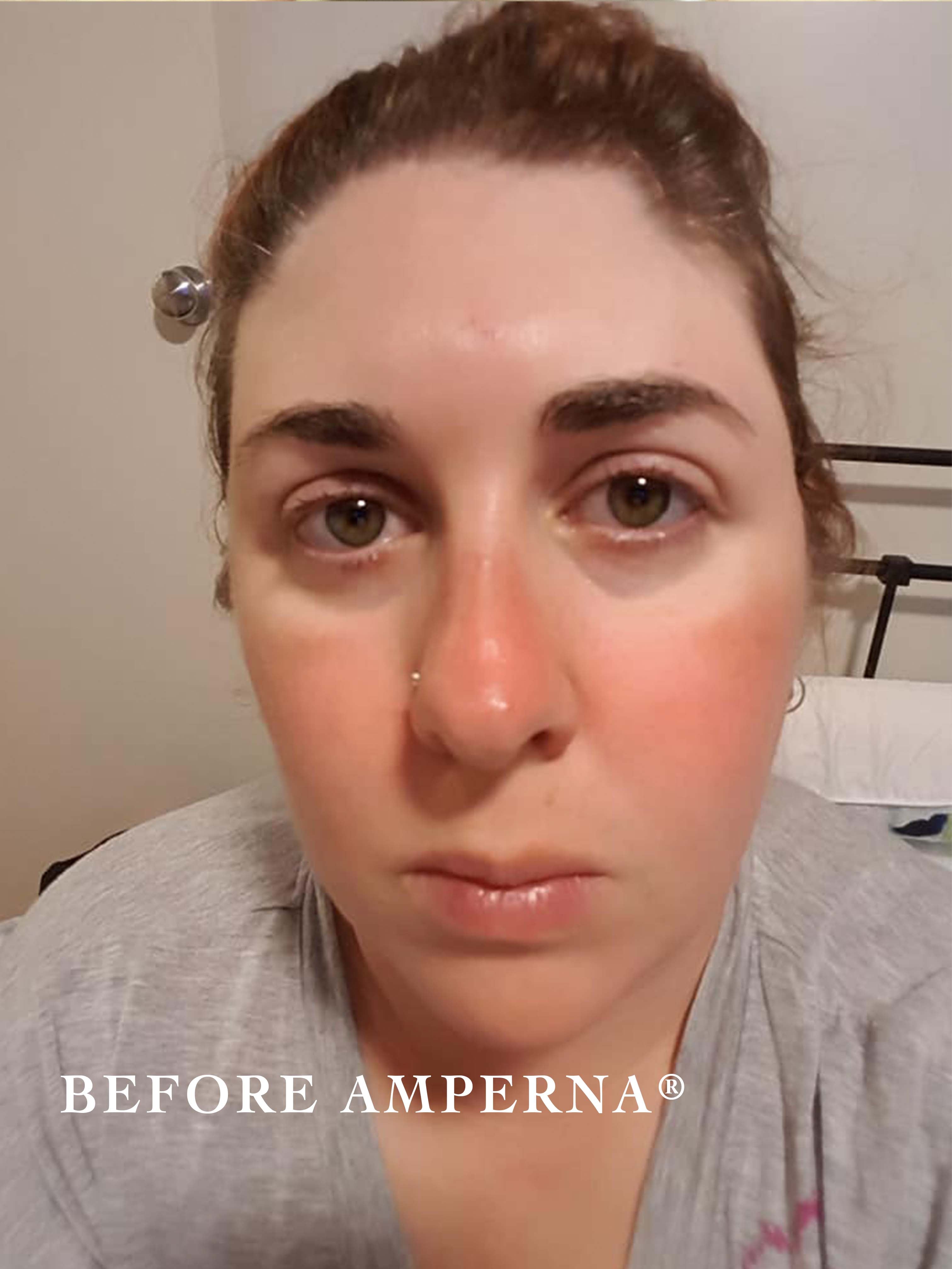 rosacea_before.jpg