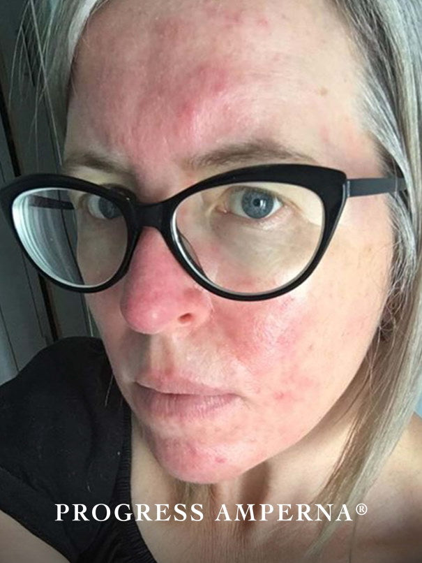 rosacea_wanita_after.jpg